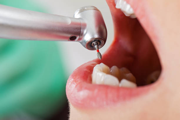 Best Emergency Dentist for Knocked-Out Tooth in Dalton, OH